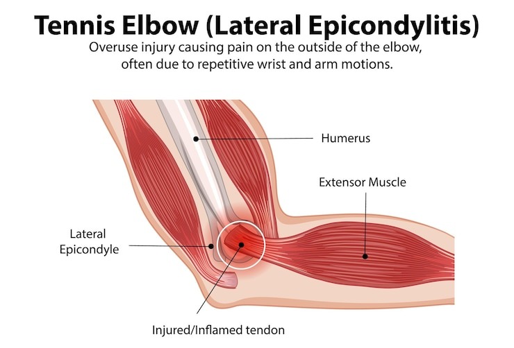 Tennis elbow